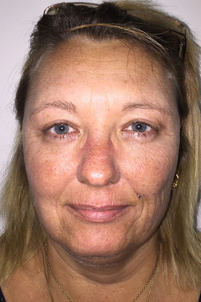 Before & After — after (post-operative)